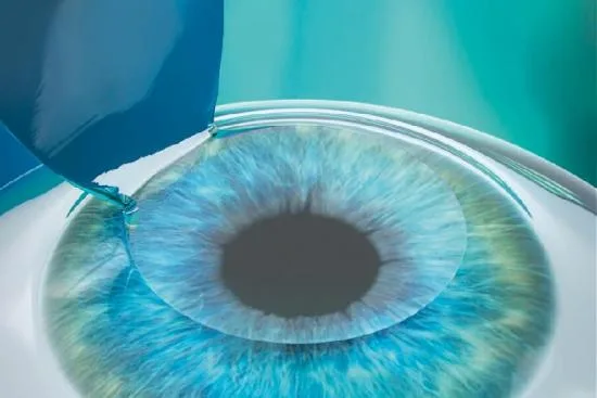 Femto-LASIK et laser Presbyond Femto-LASIK et laser Presbyond