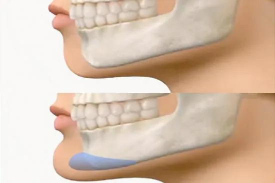 Chin surgery indications: How genioplasty enhances facial harmony 2026 Chin surgery indications: How genioplasty enhances facial harmony 2026