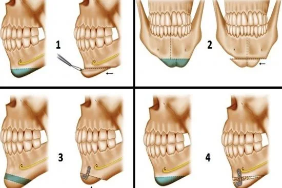 Turquie Santé: Your trusted partner for successful genioplasty 2026 Turquie Santé: Your trusted partner for successful genioplasty 2026