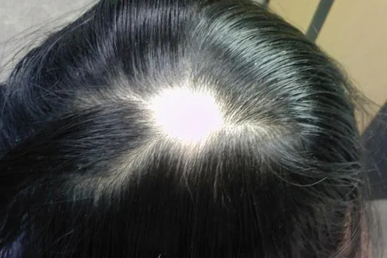 زراعة الشعر دون الحاجة إلى الحلاقة الكاملة 2026 زراعة الشعر دون الحاجة إلى الحلاقة الكاملة 2026