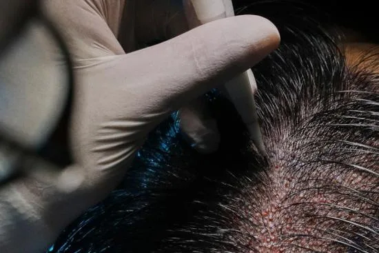 هل يمكن تجنب الحلاقة الكاملة أثناء عملية زراعة الشعر؟ 2026 هل يمكن تجنب الحلاقة الكاملة أثناء عملية زراعة الشعر؟ 2026