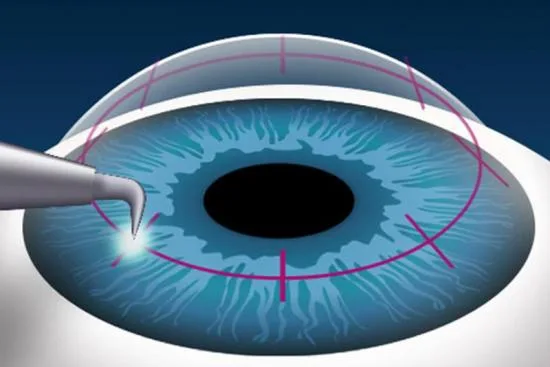 Different types of corneal transplant procedures in Istanbul, Turkey 2026