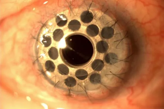 Corneal diagnosis: In which cases? 2026