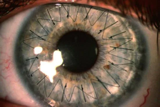 What is a cornea transplant? 2026