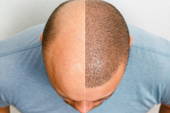 Greffe de cheveux sans rasage