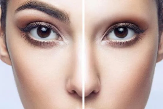 Greffe des sourcils 