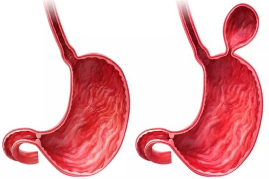 Surgery of hiatal hernia