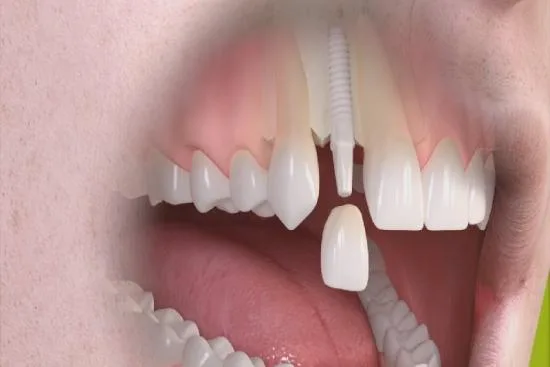 El procedimiento Hollywood Smile en Turquía El procedimiento Hollywood Smile en Turquía