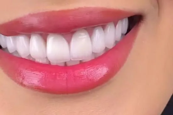Técnicas y procedimientos del Hollywood Smile Técnicas y procedimientos del Hollywood Smile