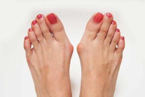 Bunion Surgery