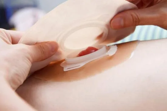 What is an ileostomy? 2026