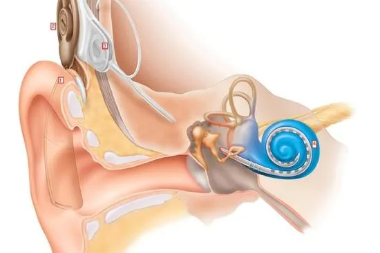 Types of cochlear implants