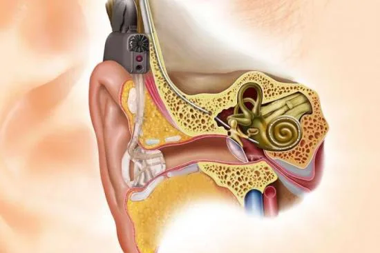 Adaptación de implantes auditivos Adaptación de implantes auditivos