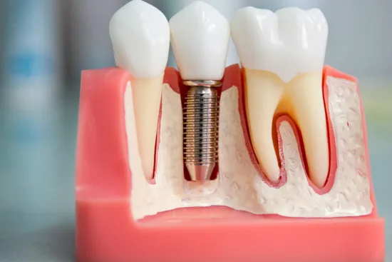 Mantenimiento de un implante dental 2026