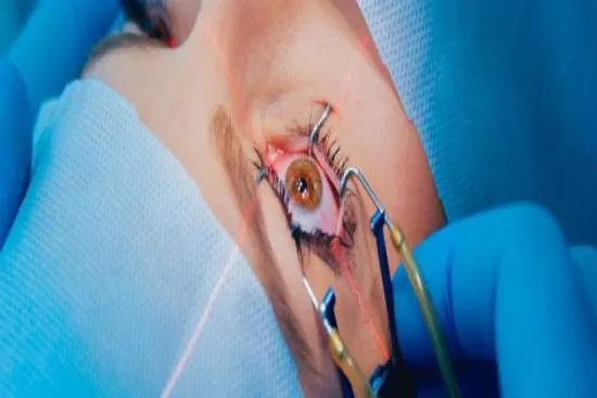 Iridectomy procedure Iridectomy procedure