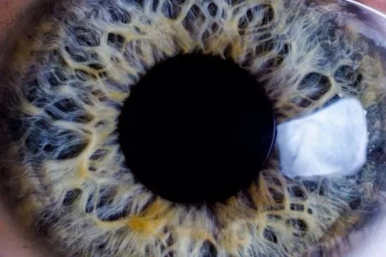 Glaucoma de ángulo cerrado: síntomas comunes 2026