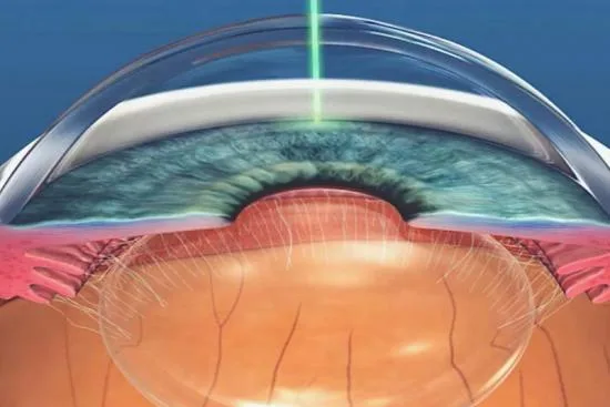 Iridoplastia: tratamiento con láser del glaucoma de ángulo cerrado 2026