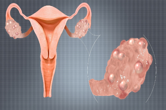 Removal of Ovarian Cysts