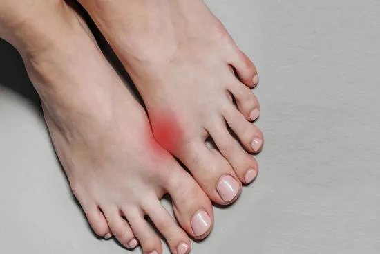 Complications de l'Hallux Valgus