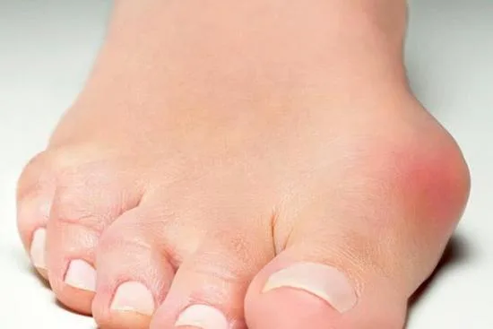 Résultats de l'hallux valgus