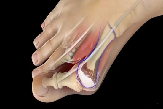 L'opération d'un hallux valgus en Turquie