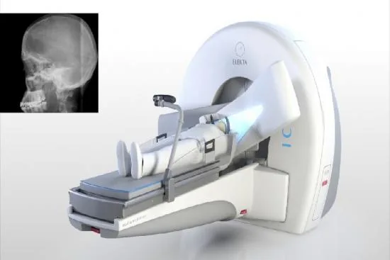 Gamma Knife radiosurgery: How does it work? 2026 Gamma Knife radiosurgery: How does it work? 2026