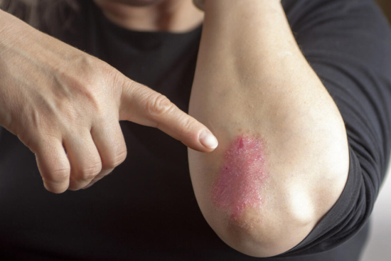 Tratamiento de la psoriasis