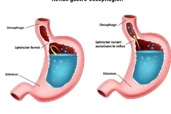 reflux gastrique reflux gastrique