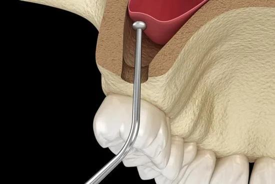 Sinus lift en Turquie Sinus lift en Turquie
