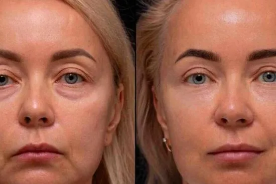 What is facial lipofilling? 2026 What is facial lipofilling? 2026