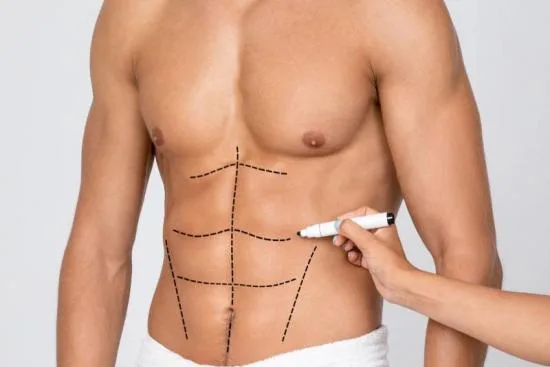 Liposucción abdominoplastia Liposucción abdominoplastia