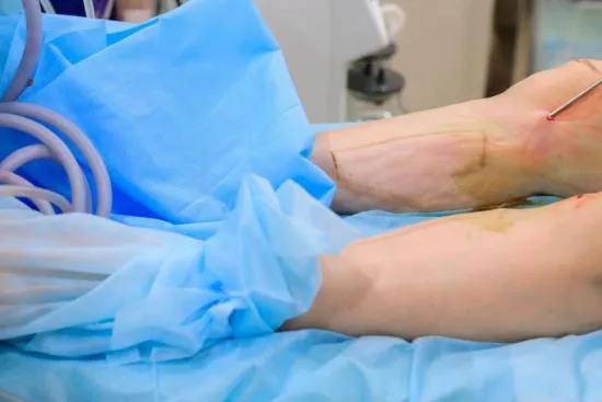 Leg liposuction Turkey