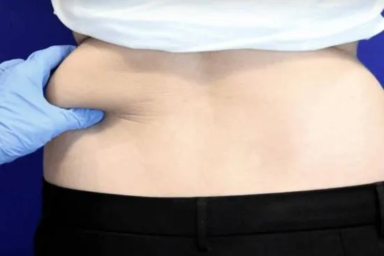 Liposuction of love handles in Turkey Liposuction of love handles in Turkey