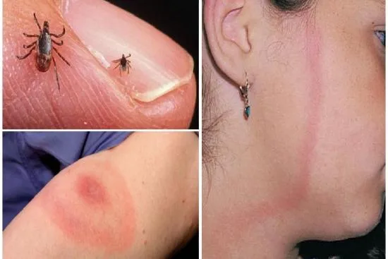 Diagnostic de la maladie de Lyme 