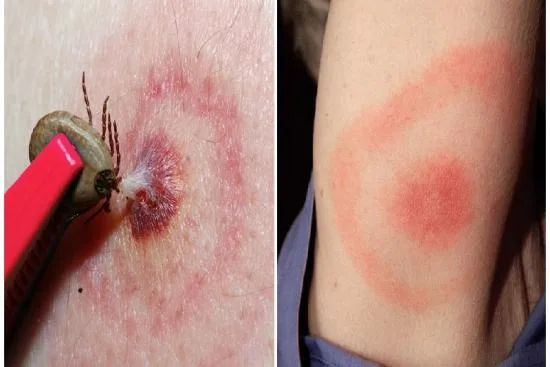Traitement de la borréliose de lyme en Turquie