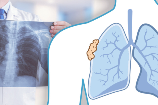 Tratamiento del mesotelioma pleural