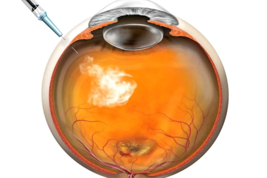 Anti-VEGF Therapy