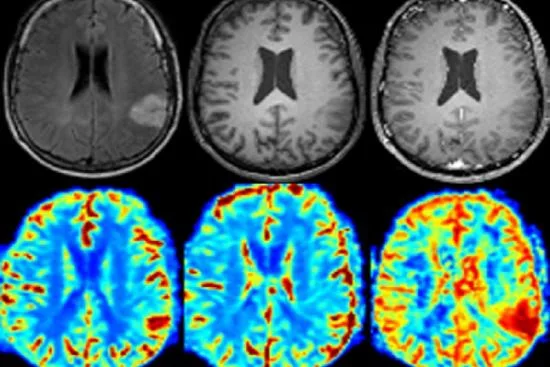 Brain tumor surgery in Turkey Brain tumor surgery in Turkey