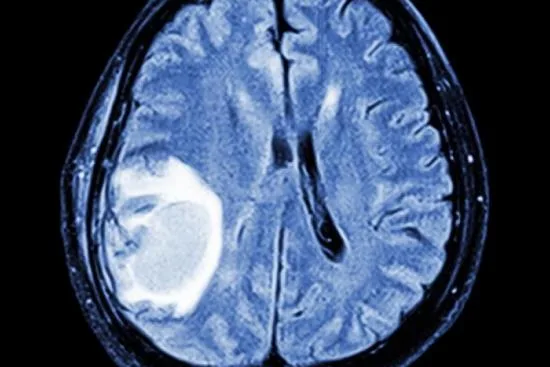 Meningioma treatment Meningioma treatment