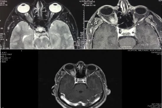 Meningioma surgery cost Meningioma surgery cost