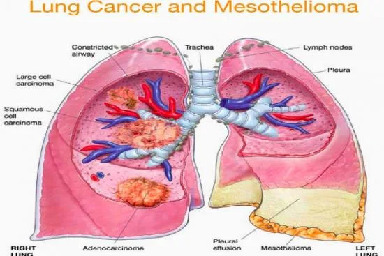 Traitement du mésothéliome pleural 2 Traitement du mésothéliome pleural