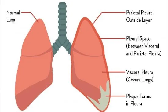 Diagnostic du mésothéliome pleural Diagnostic du mésothéliome pleural