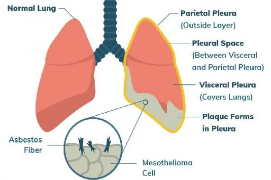 mésothéliome pleural mésothéliome pleural