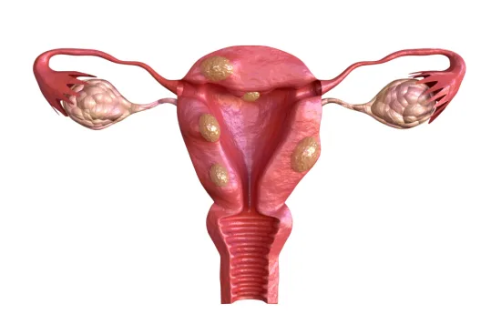 Myomectomy techniques in Turkey 2026