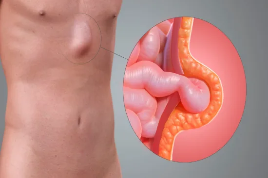 Diagnóstico de una hernia umbilical en Turquía Diagnóstico de una hernia umbilical en Turquía