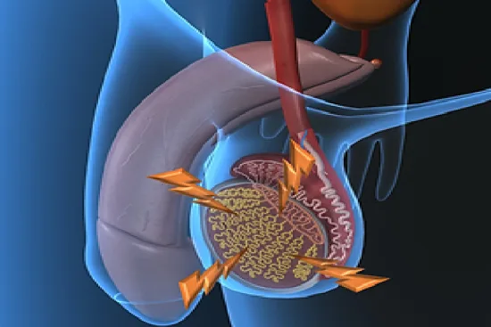 Orchidectomie : Ablation des testicules Orchidectomie : Ablation des testicules