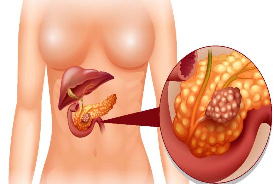 Total pancreatectomy