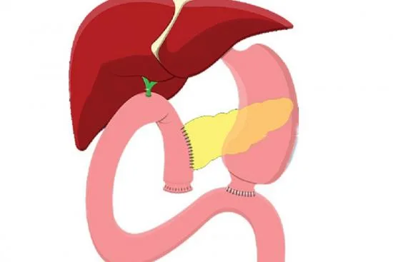 Cáncer de páncreas: por qué la pancreatectomía total 2026 Cáncer de páncreas: por qué la pancreatectomía total 2026