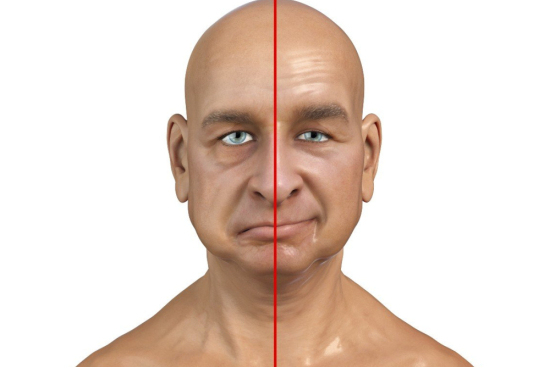 علاج شلل بيل