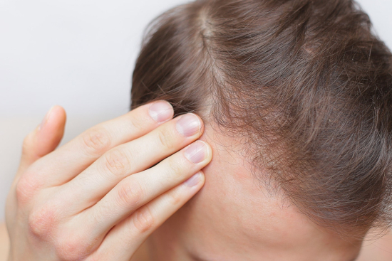 Tratamiento hormonal para la caída del cabello